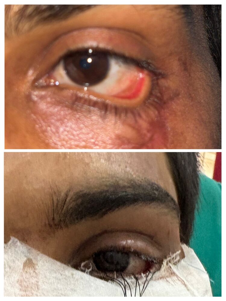 स्किन ग्राफ्टिंग से मरीज के पलक का सफल पुनर्निर्माण, युवक को नई दृष्टि और सामान्य जीवन की ओर लौटने का मिला अवसर